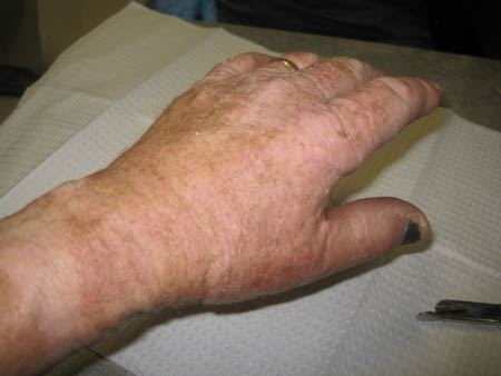 Looks pretty good... Doc says another two weeks