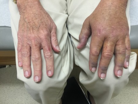 The doctor said "Hey, Sue, No more sausage fingers!"