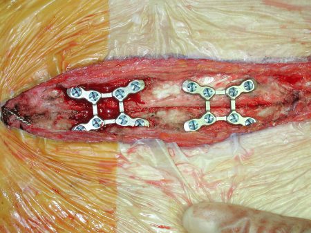 Paul had the plates plus the normal wires to close up the sternum after the operation