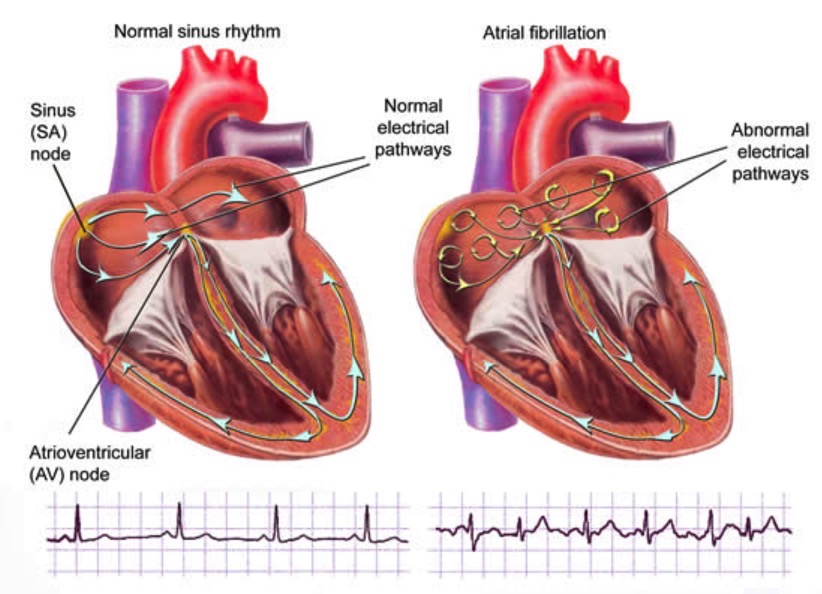 Caridiac ablation explained