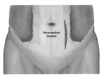 Surgical Approach