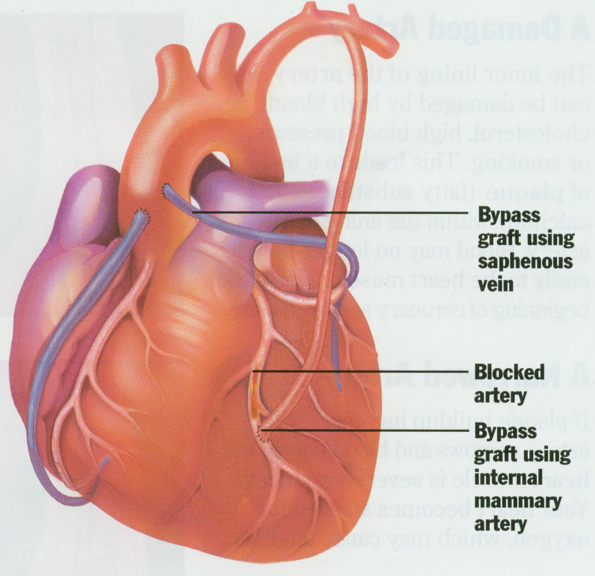 The problem is solved with a heart bypass operation