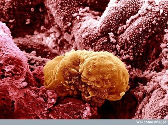 Colored Image of a 6 day old Human Embryo Implanting itself onto the wall of the womb
